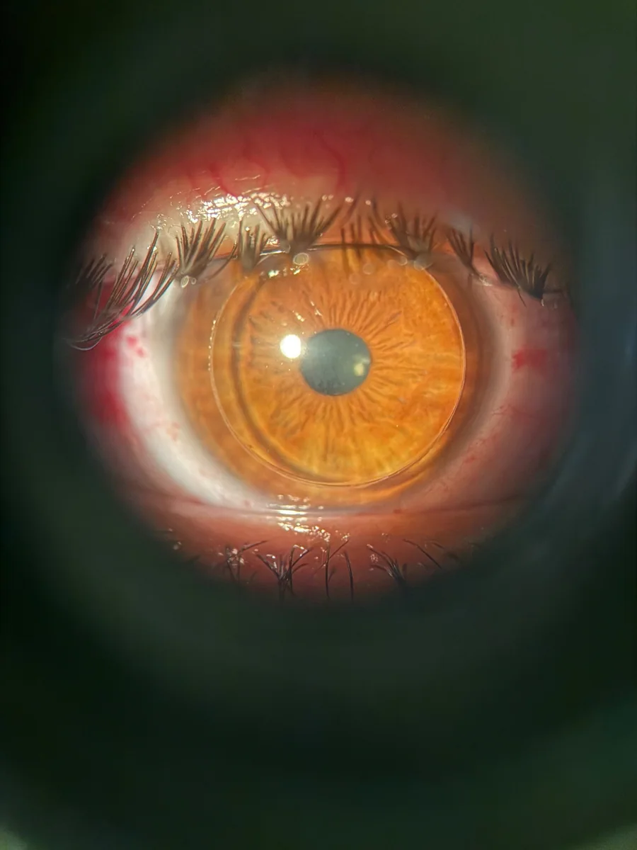 Fotografía clínica del segmento anterior del ojo